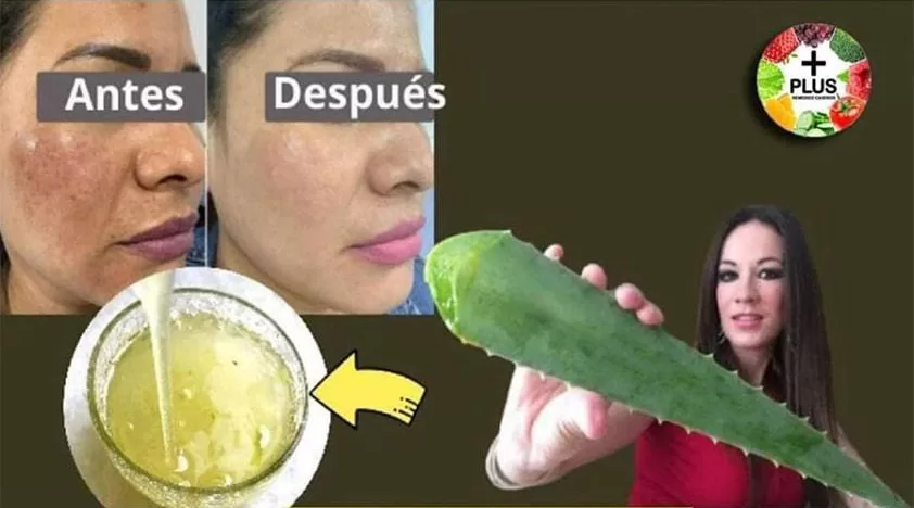 Como Eliminar las Verrugas Con Vinagre De Manzana