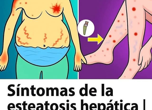 Esteatosis Hepática: Síntomas y Signos Tempranos del Hígado Graso