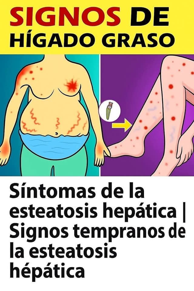 Signos de esteatosis hepática