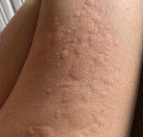 Cuidado con las Picaduras en la Piel: Posibles Causas y Remedios Naturales