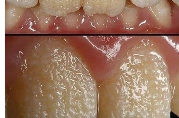 Cuida Tu Sonrisa: Remedios Naturales para Dientes Saludables