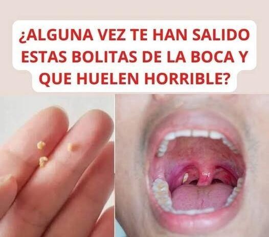 Bolas de amígdalas: ¿Qué son y cómo puedes mejorar este problema?