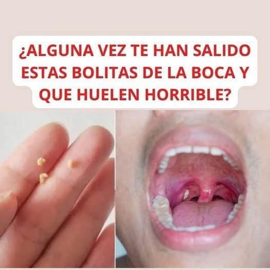 Bolas de amígdalas