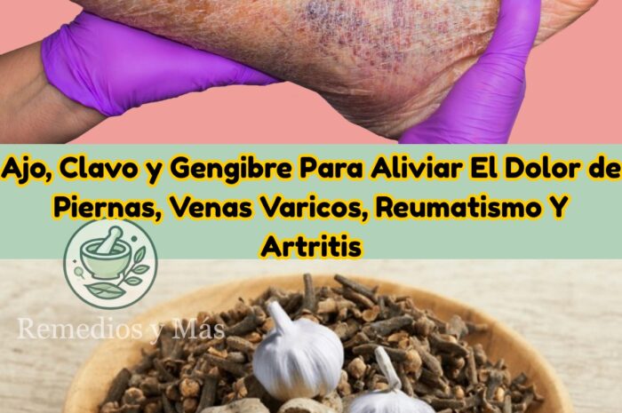 Remedio Natural Para Aliviar el Dolor de Piernas y Venas Varicosas