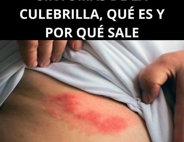 Todo sobre la Culebrilla: Síntomas, Causas y Remedios Naturales