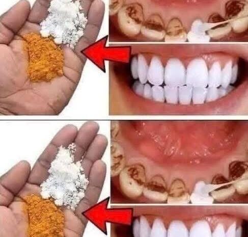 Blanqueamiento Dental Casero: Cómo Obtener Dientes Más Blancos de Forma Natural