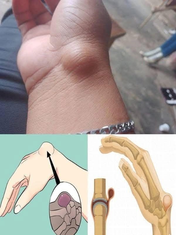 Diagrama de quiste sinovial en la muñeca