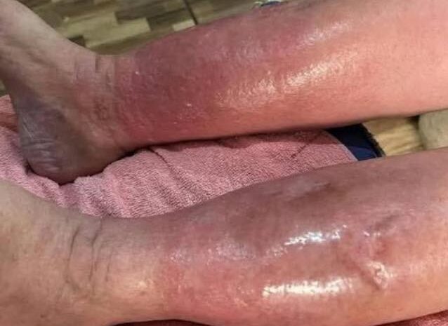 Signos Claros de Infecciones Cutáneas y Remedios Naturales