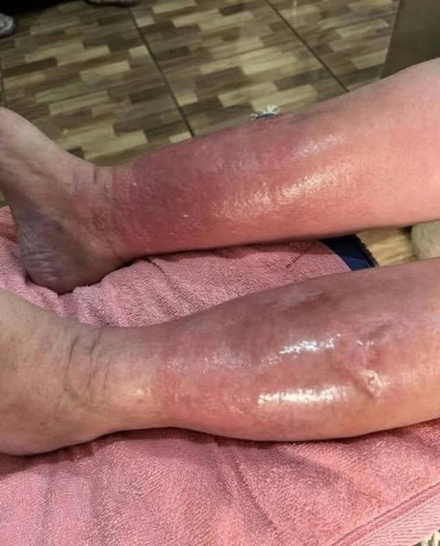 Piernas con enrojecimiento e inflamación