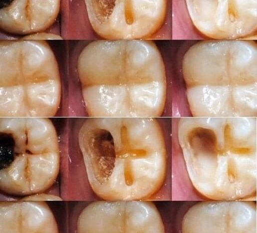 Cómo Reparar una Caries de Forma Natural: Consejos y Remedios Caseros