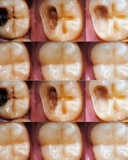 Proceso de restauración dental