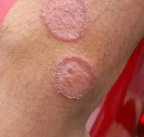 Signos Comunes de Irritaciones Cutáneas y Remedios Naturales