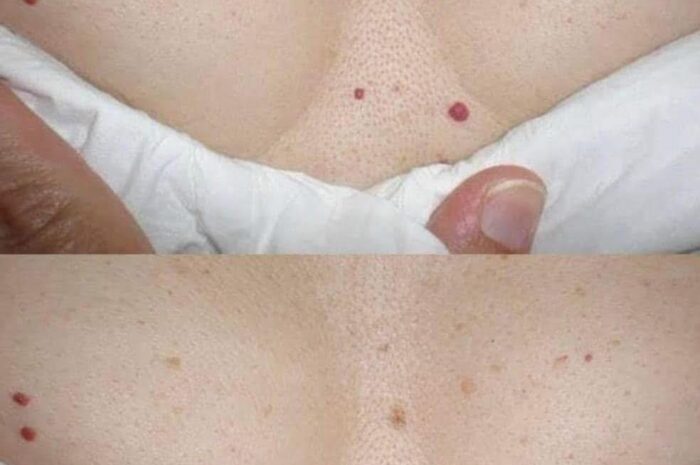 ¿Tienes Puntos Rojos en la Piel? Descubre sus Causas y Remedios Naturales
