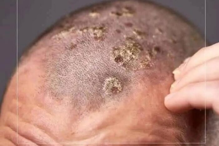 Remedios Naturales para Combatir Contagios Comunes