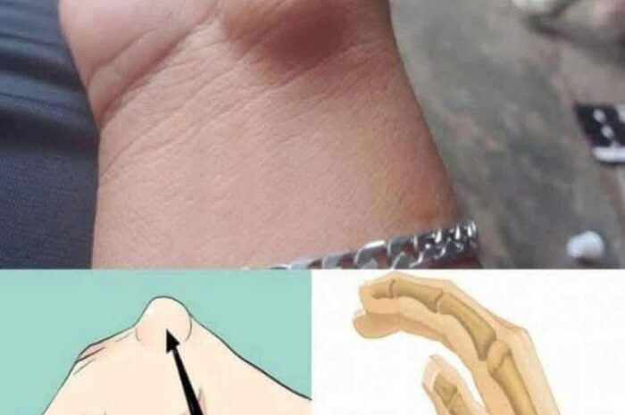 Gangliones en la Muñeca: Síntomas, Causas y Remedios Naturales