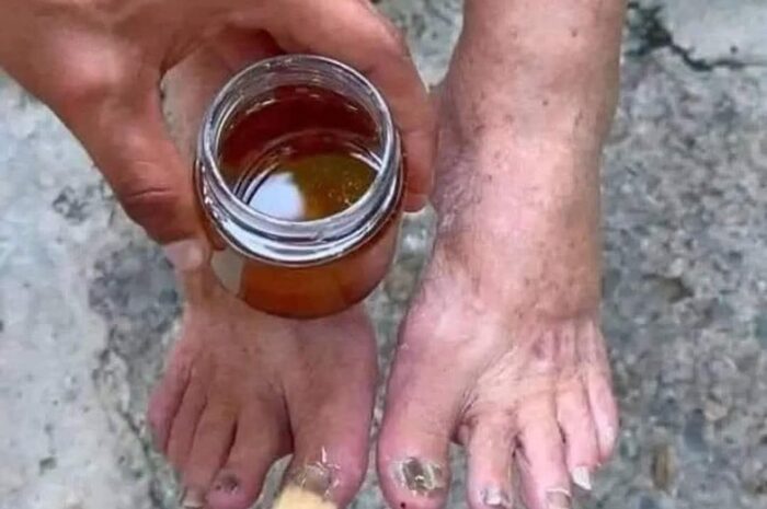 Rompe Hongos: Un Remedio Casero para Combatir Infecciones en los Pies
