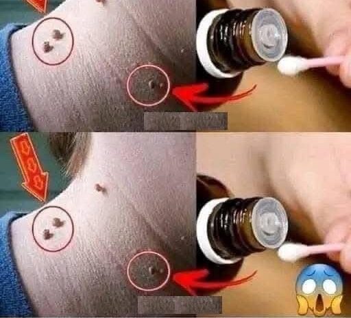 Elimina Verrugas de Forma Natural: Tratamiento Casero Efectivo