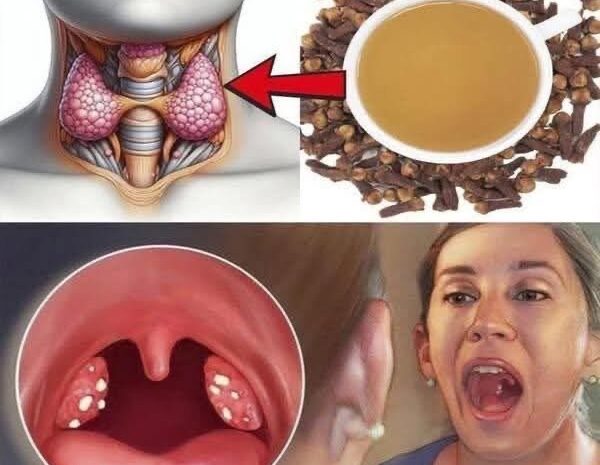 Antibiótico Natural: Alivio para el Dolor de Garganta con Clavos de Olor