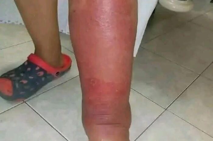 Signos de Inflamación Cutánea: Reconociendo la Celulitis y su Tratamiento