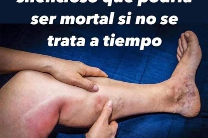 Trombosis: Un Mal Silencioso que Puede Ser Mortal