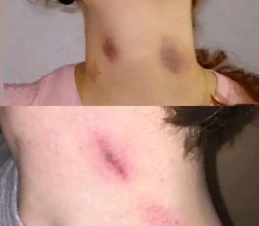 Remedios Naturales para Tratar Moretones de Forma Efectiva