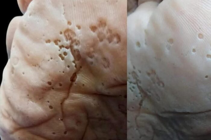 ¡Cuidado! La Infección Bacteriana que Puede Devorar la Piel de Tus Pies Sin Que Lo Notes