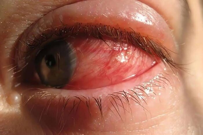 Consecuencias de Dormir Con el Ojo Irritado: Remedios Caseros para el Cuidado Ocular