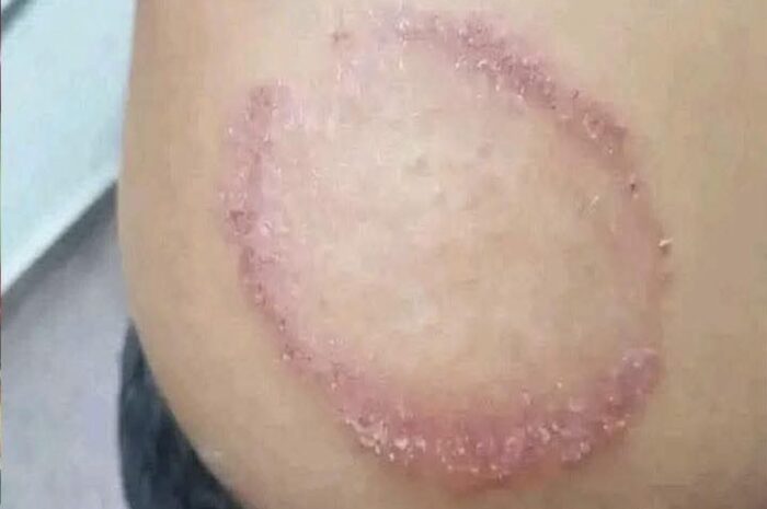 Signos de Infecciones en la Piel y Remedios Naturales