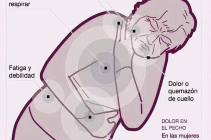 Señales de Alerta: Infarto en Mujeres y Cómo Reconocerlo