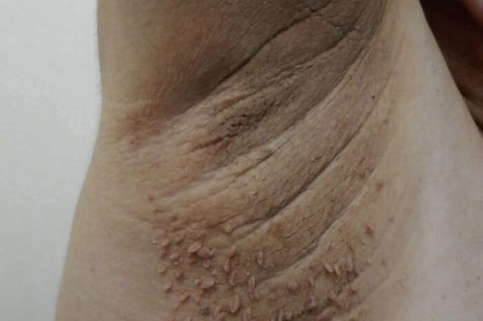 Síntomas y Remedios Naturales para Afecciones Cutáneas Comunes