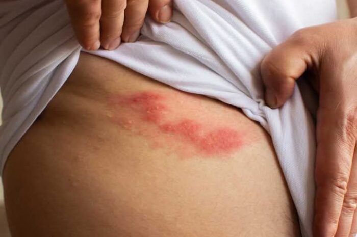 El Estrés y sus Efectos en la Piel: Cómo Combatirlo con Remedios Naturales