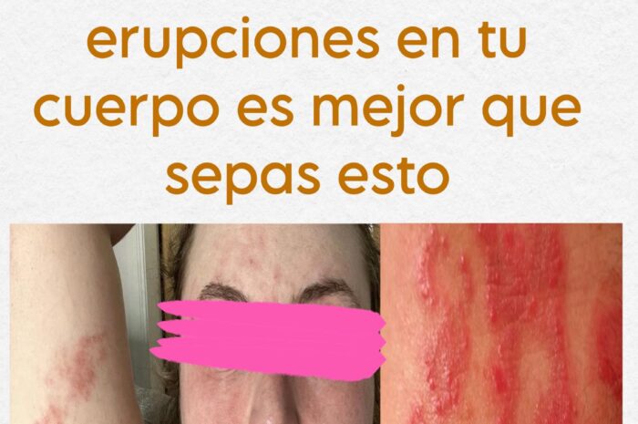 Todo sobre el H3rpes Zóster: Síntomas, Estrés y Remedios Naturales