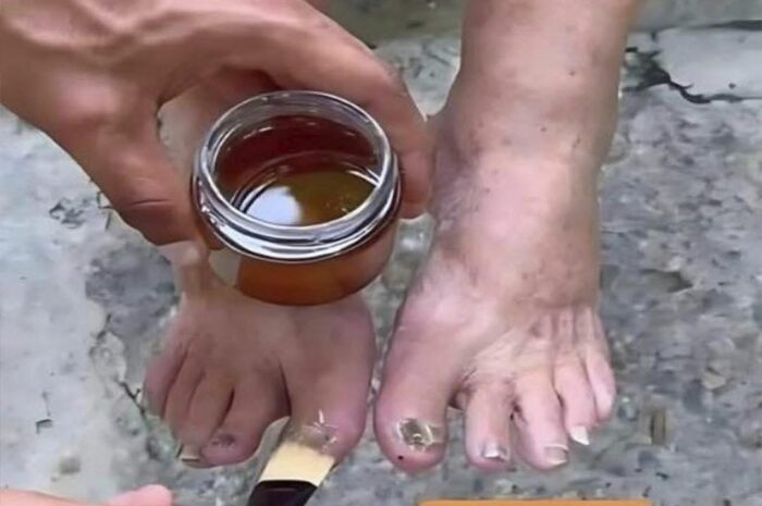 Rompe Hongos: Tratamientos Naturales para Pies Saludables