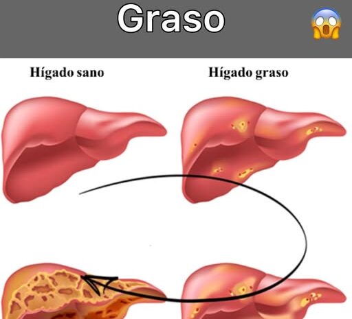 Cuídate del Hígado Graso: Aprende Cómo Limpiar tu Hígado de Manera Natural