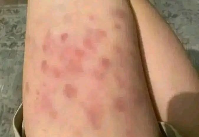 Moratones en el Cuerpo: Causas y Remedios Naturales