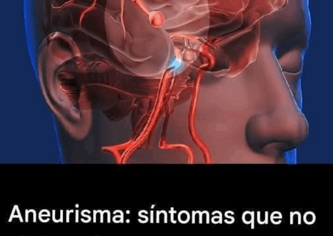 Aneurisma Cerebral: Síntomas que No Debes Ignorar