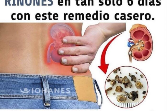 Expulsa las Piedras de tus Riñones de Forma Natural y Efectiva en 6 Días