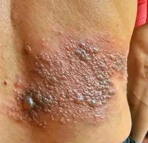 Cómo Identificar y Tratar Erupciones Cutáneas: Consejos y Remedios Naturales