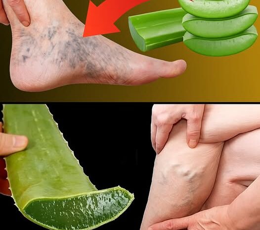 Dile Adiós a las Varices y la Pesadez de Piernas con Aloe Vera: Un Remedio Natural y Efectivo