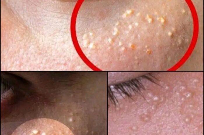 Cómo Eliminar las Bolitas Blancas de la Piel de Forma Natural
