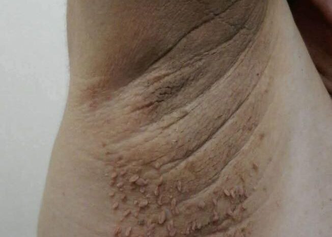 Descubriendo los Primeros Síntomas de la Salud Deteriorada: Remedios Naturales para Combatirlos