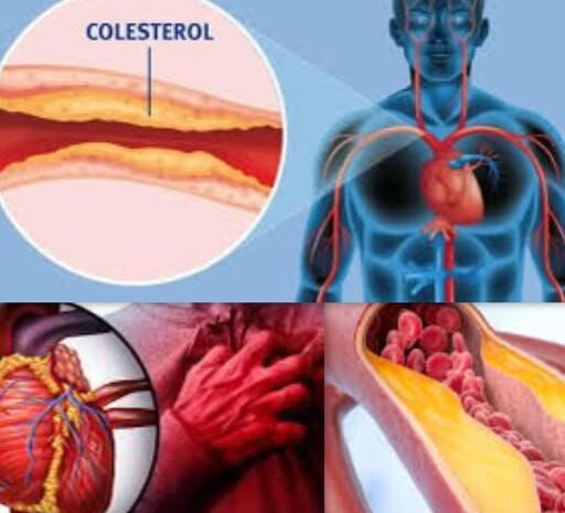 Beneficios del Colesterol Alto: Una Nueva Perspectiva