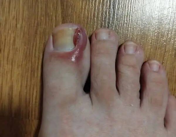 Cómo Tratar un Uñero en Casa: Consejos y Remedios Naturales