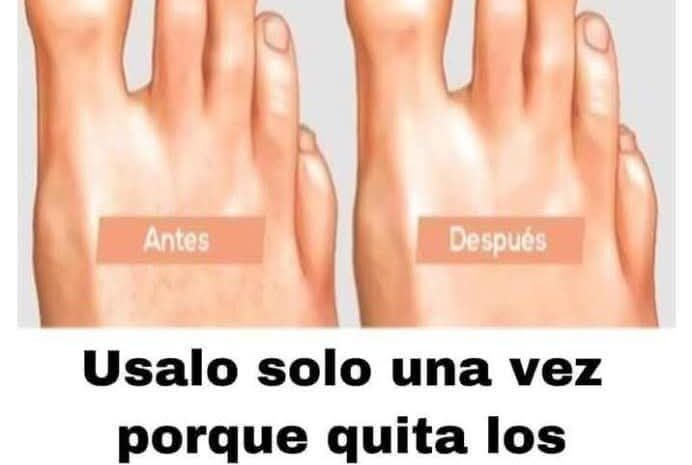 El «Rompe Hongos»: La Solución Efectiva para las Uñas Afectadas