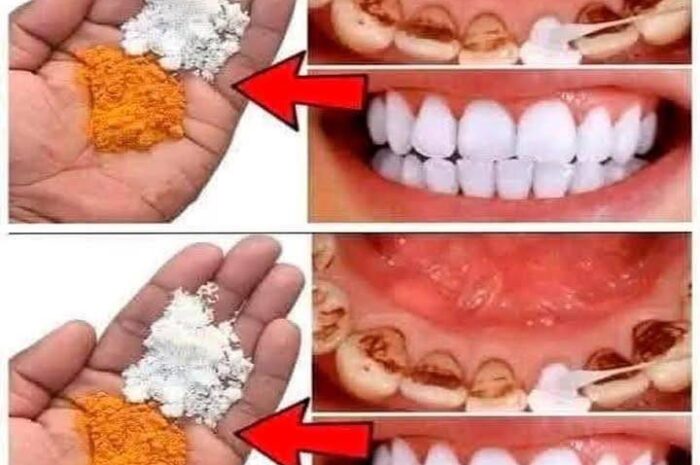 Blanqueamiento Dental Rápido y Efectivo: Un Remedio Casero con Cúrcuma y Bicarbonato