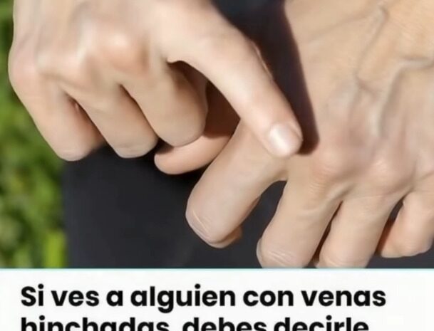 Si tienes las venas hinchadas, ESTO es lo que significa