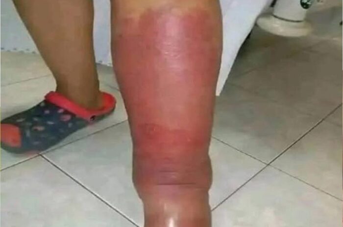 Primeros Síntomas de Inflamaciones en la Piel y Remedios Naturales