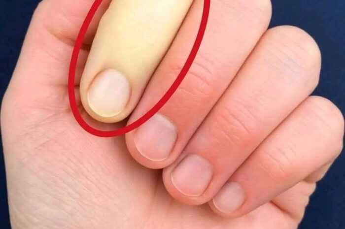 ¿Qué Sucede Cuando Tus Dedos Están Inusualmente Pálidos? Conoce las Causas y Remedios Naturales