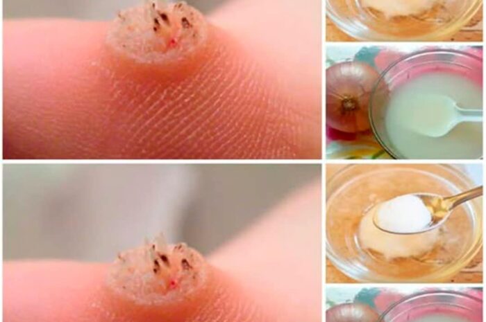 Cómo Eliminar las Verrugas de Forma Natural: Remedios Caseros y Efectivos