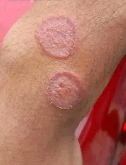 Área de piel afectada por dermatitis